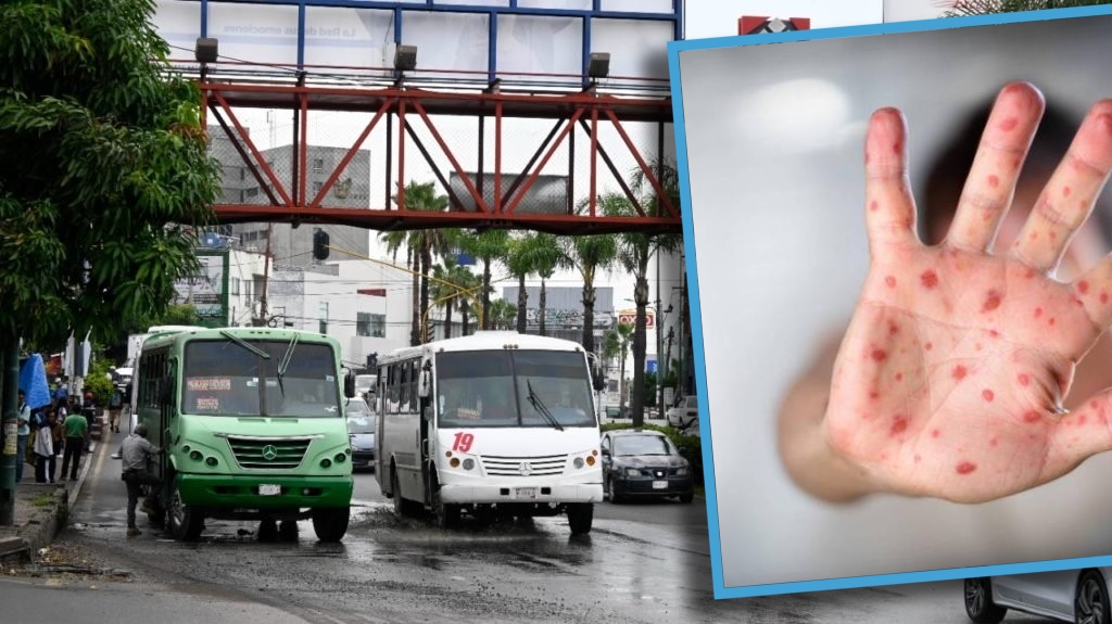 Preocupa a «ruteros» contagios de viruela del mono