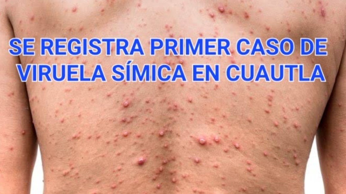 Cuautla registra primer caso de viruela del mono