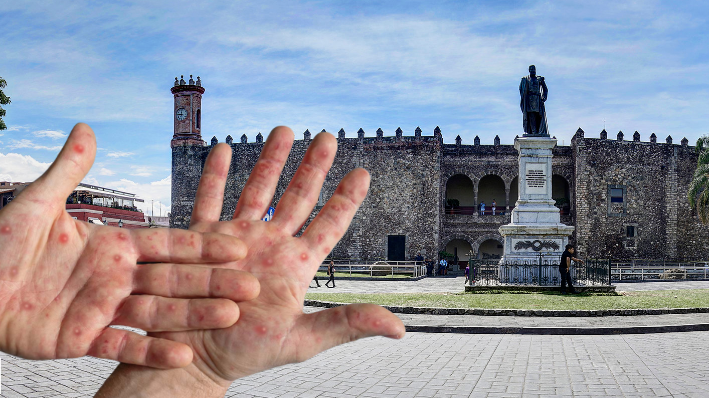 Sube a 10 el número de casos confirmados de viruela símica en Morelos