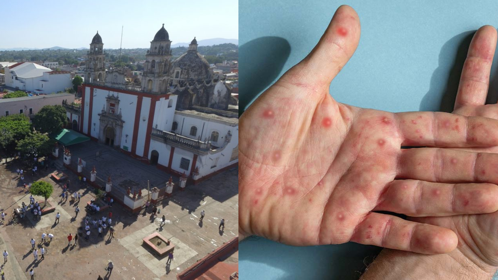 Cuautla con más casos de viruela símica: Salud