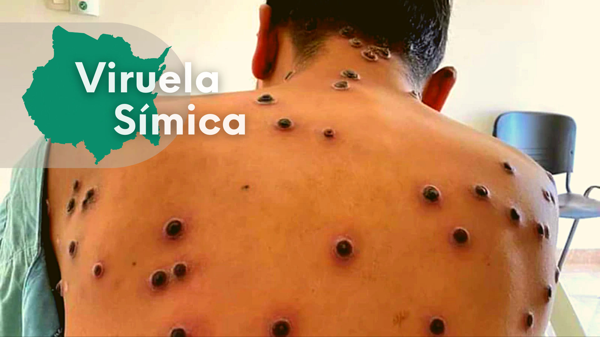 Se suma un nuevo caso de viruela símica a Morelos ya suman 25