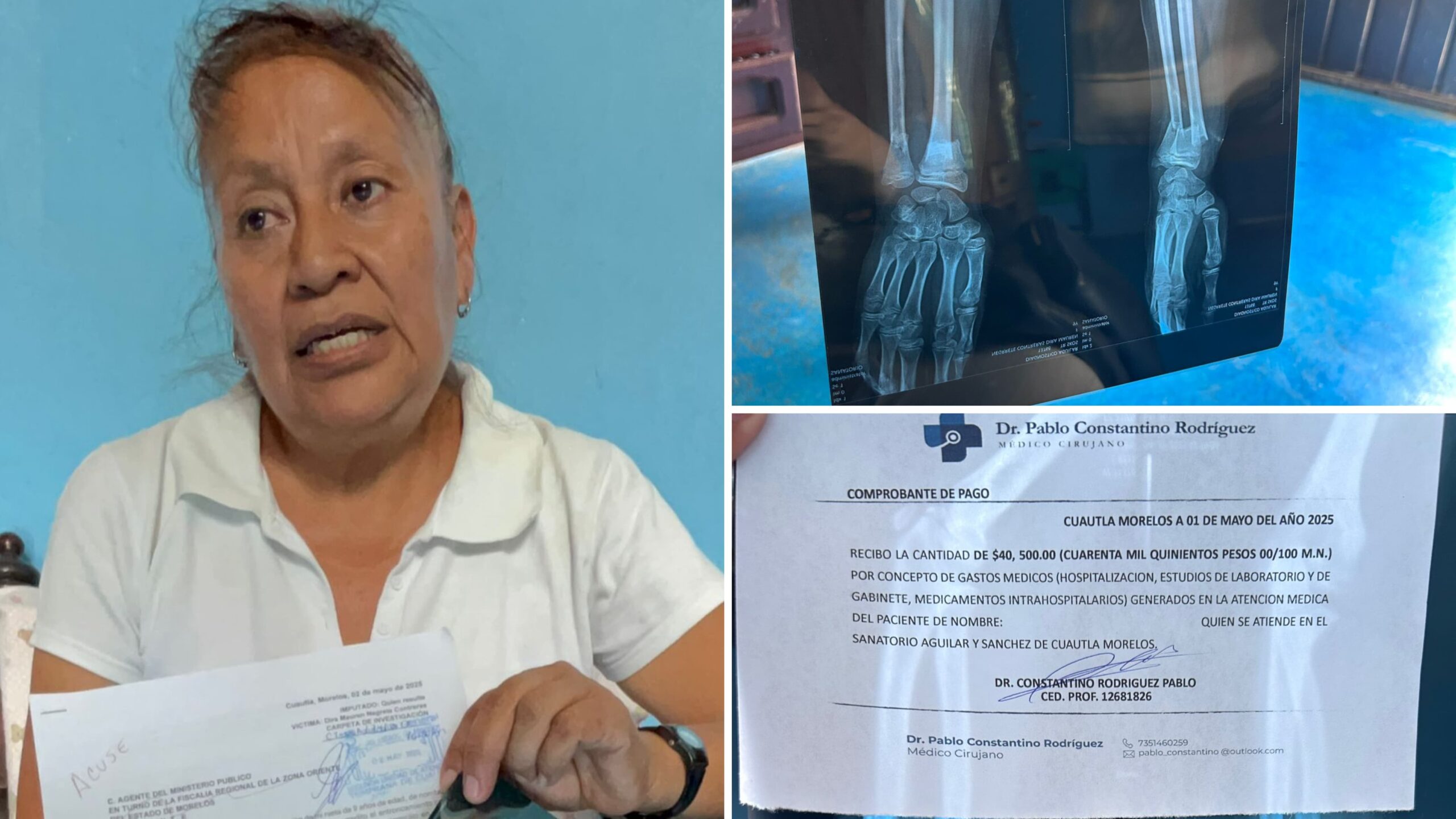 Menor sufre fractura tras presunto bullying en primaria Narciso Mendoza en Cuautla