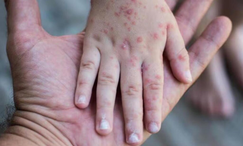 Llaman autoridades de Salud a vacunar a los niños contra el sarampión