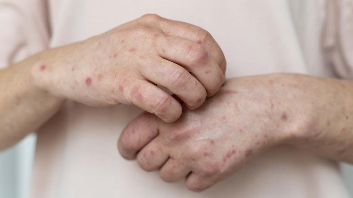 Refuerzan medidas de prevención contra el sarampión