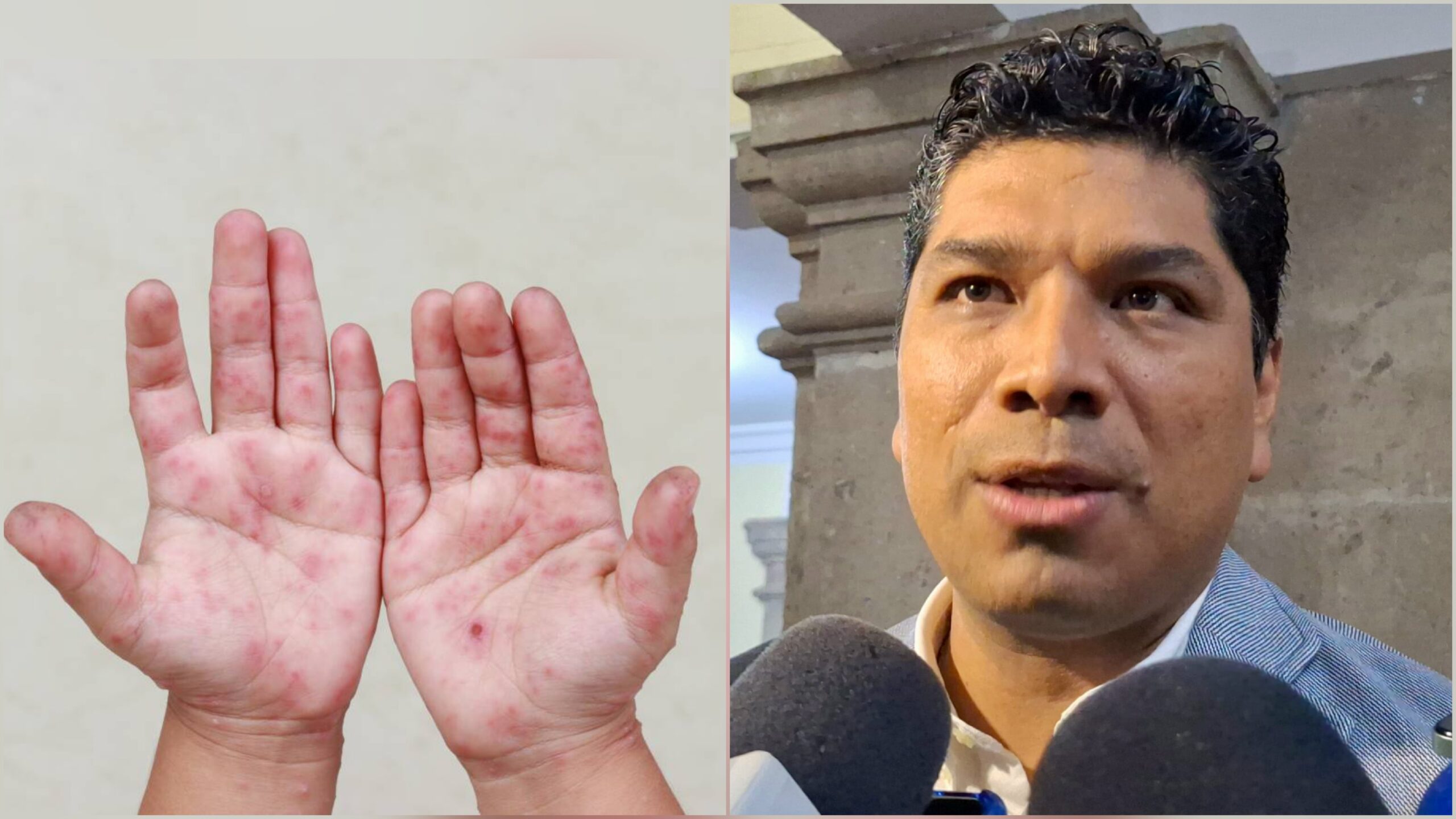 Salud Morelos pide no alarmarse ante aumento de número de casos de Coxsackie