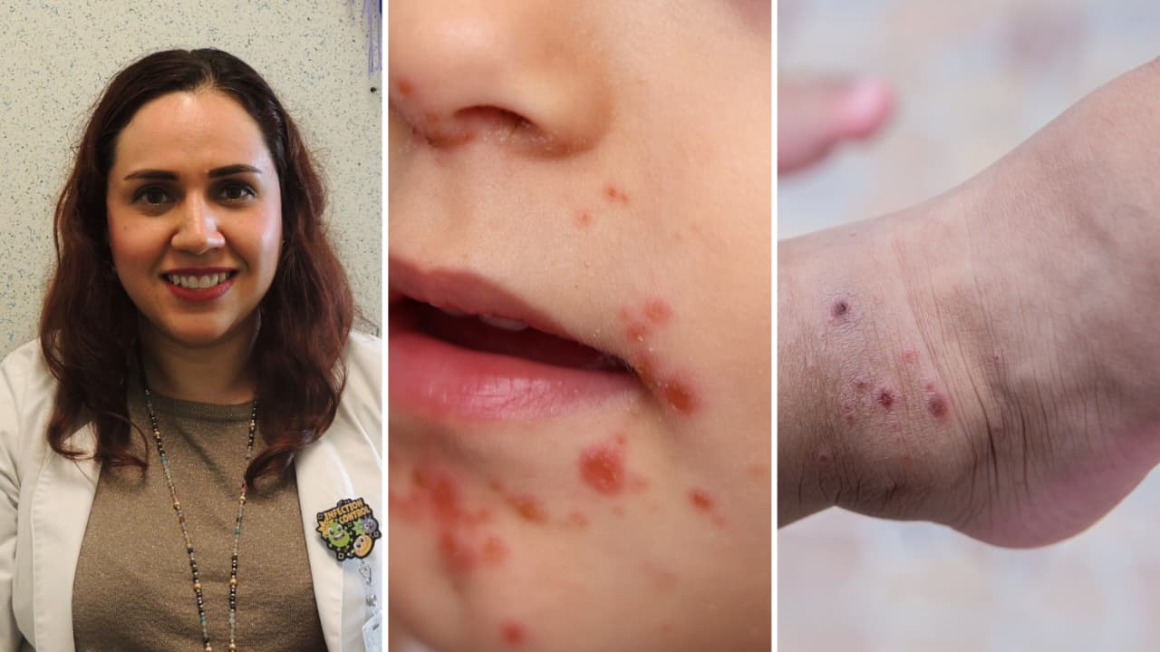 Llama Hospital de la Niñez Morelense a prevenirse contra el Coxsackie