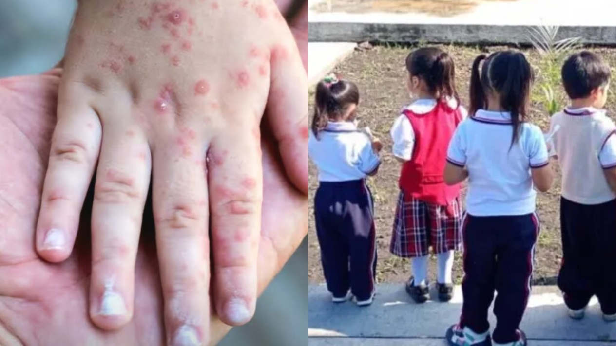 Reportan algunas escuelas casos de Coxsackie en Cuautla