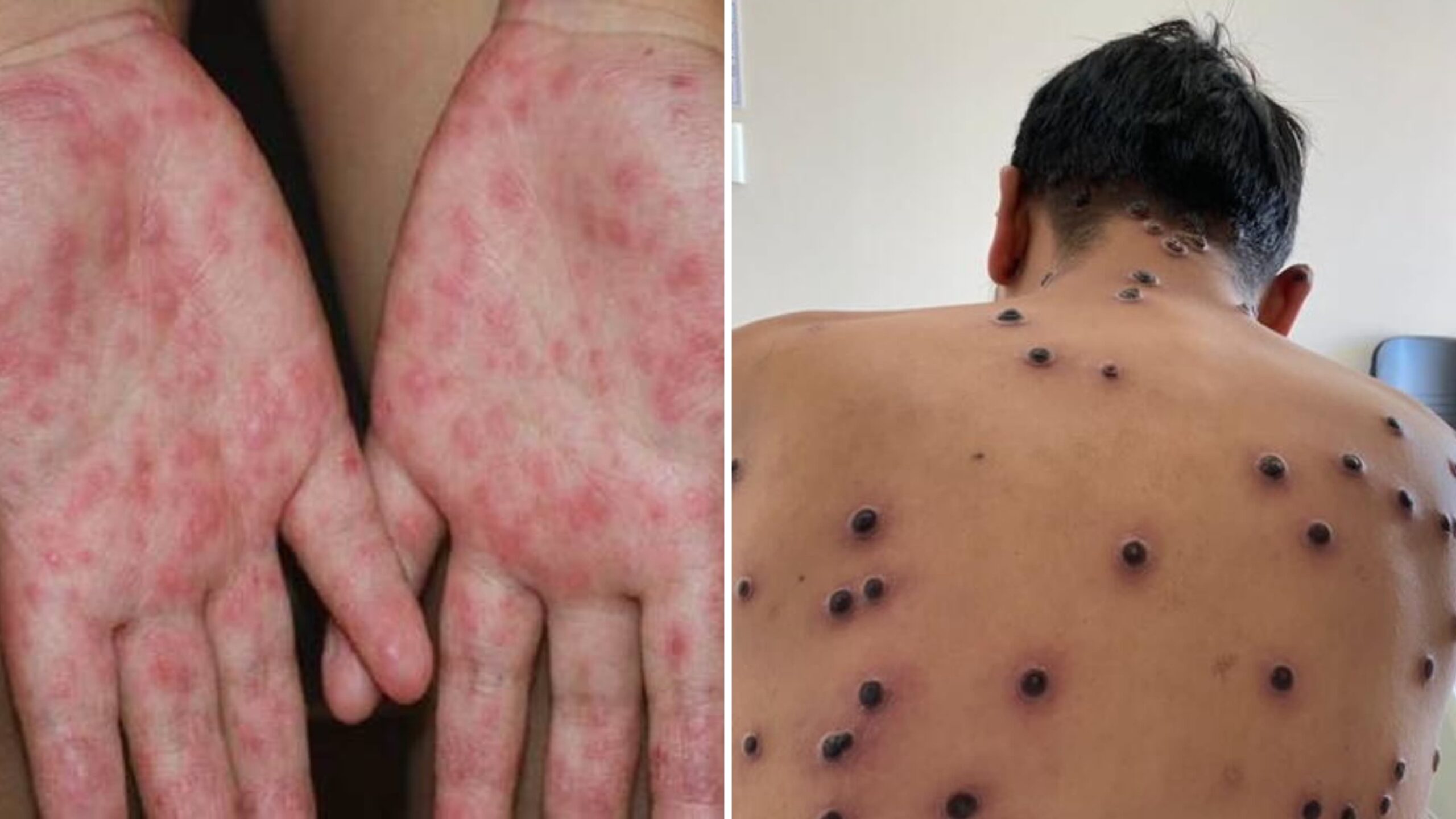 Cuautla Libre de Coxsackie y Viruela Símica