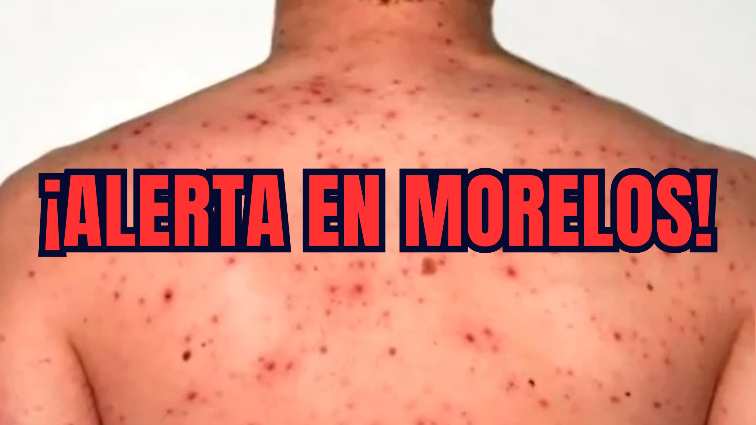 Confirman en Atlatláhucan primer caso de sarampión en Morelos