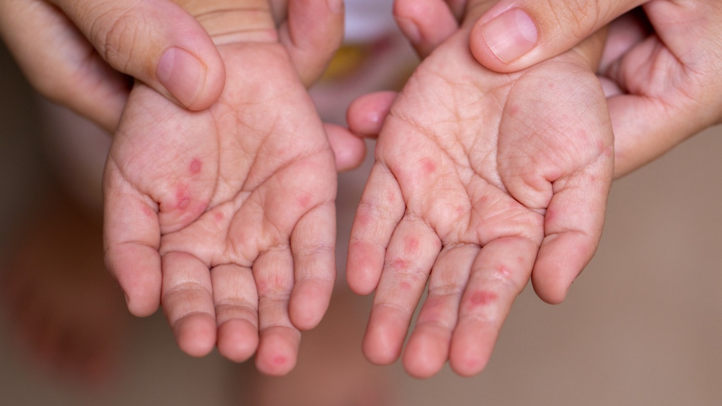 Registra Cuautla cuatro casos de coxsackie