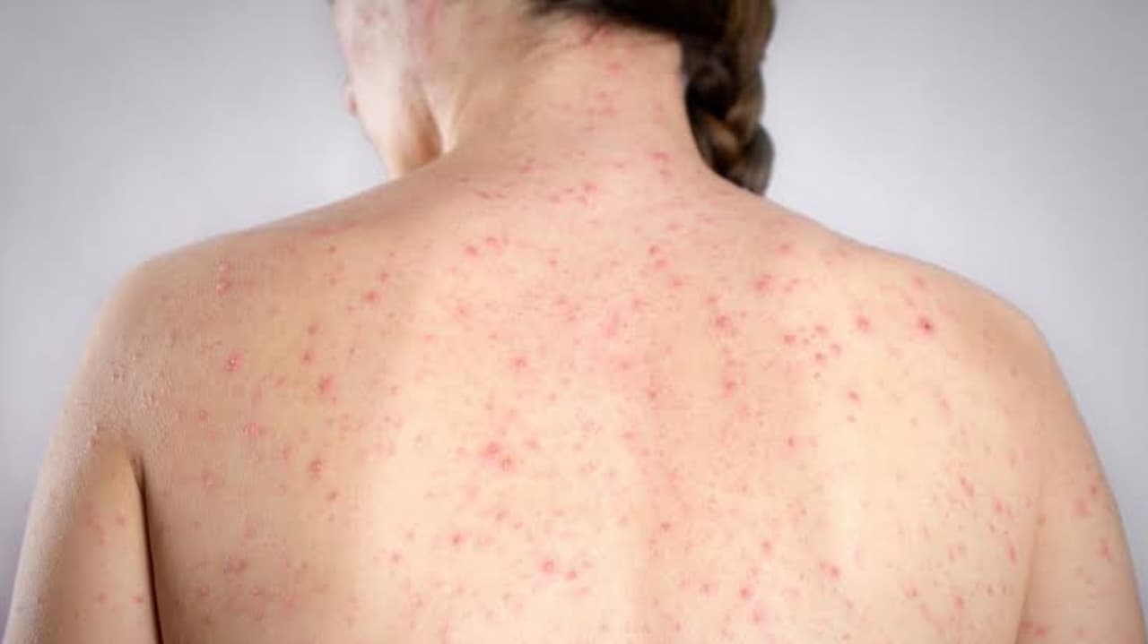 Confirma SSM caso de mujer con sarampión que trabaja en Atlatlahucan y estudia en Cuautla