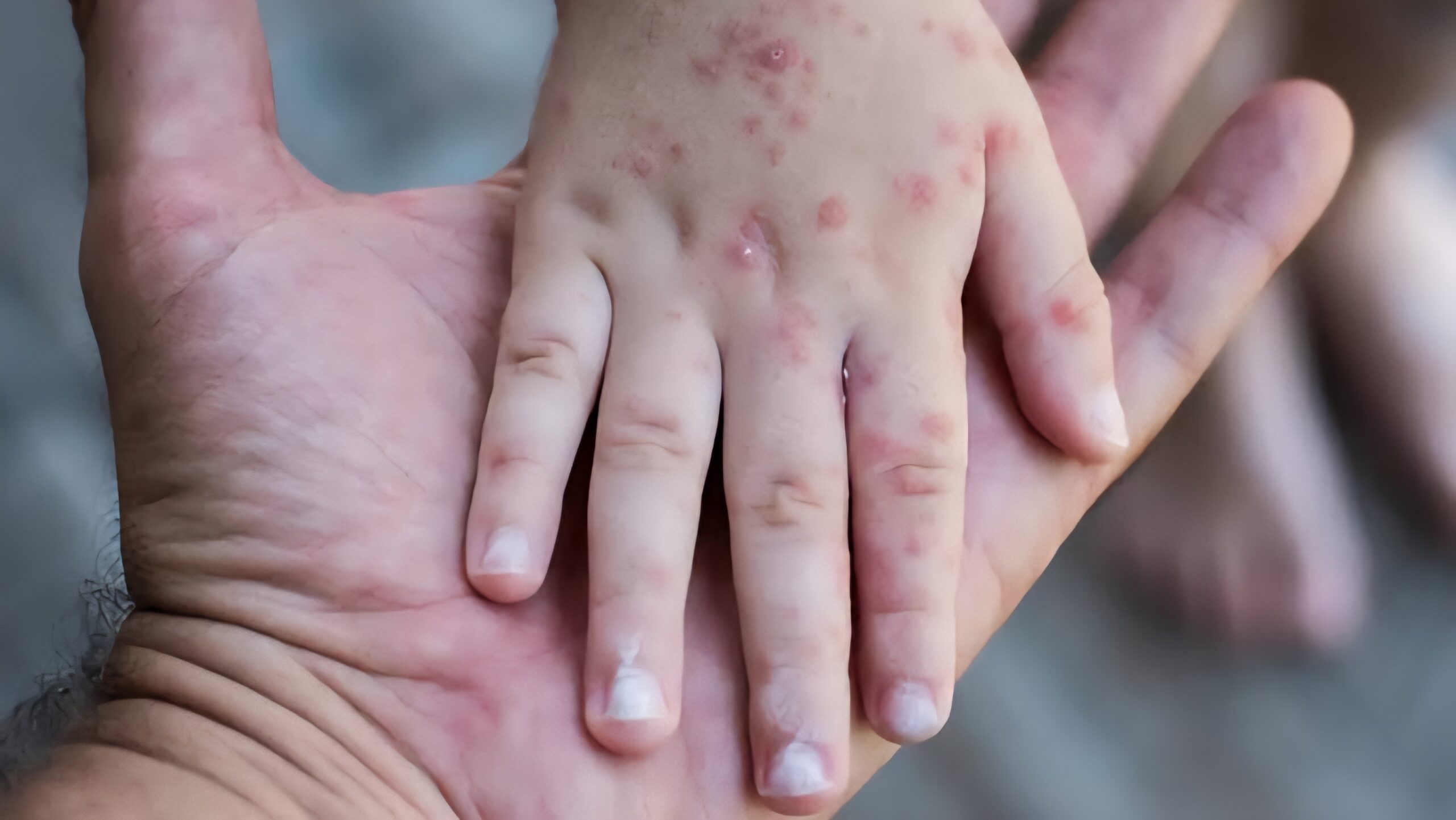 Confirma Secretaría de Salud 3 casos importados de sarampión en Jonacatepec