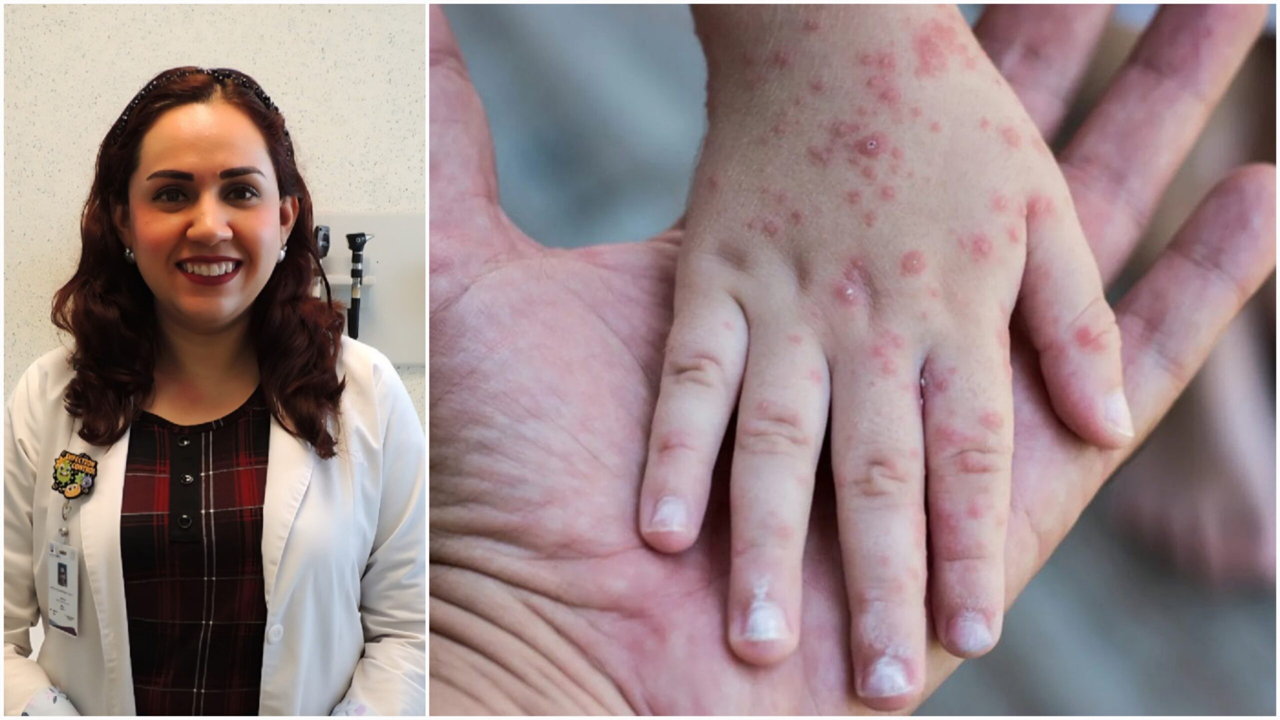 Llama Hospital de la Niñez Morelense a evitar la propagación de sarampión