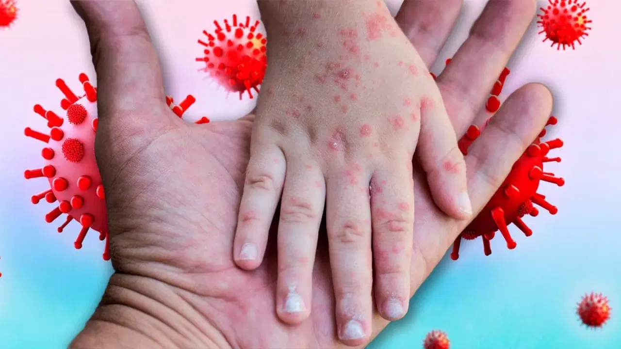 Ya son 17 casos de sarampión registrados en Morelos