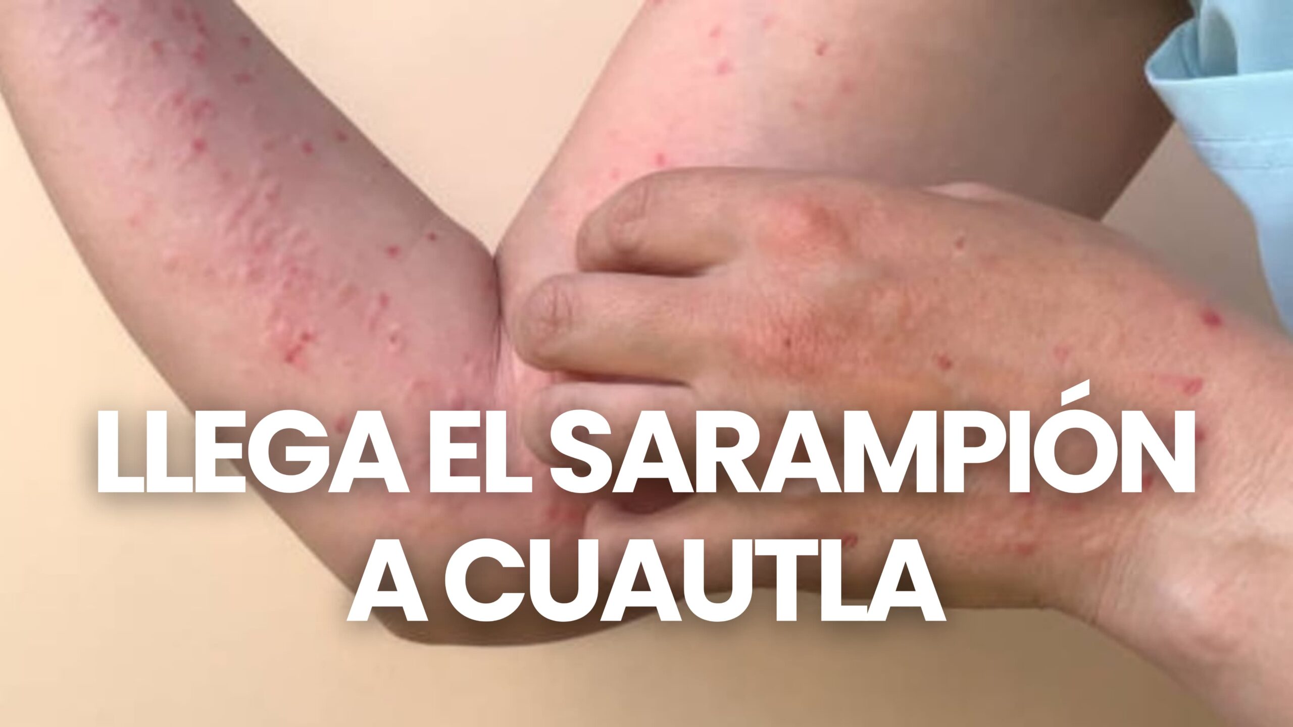 Cuautla registra dos casos de sarampión