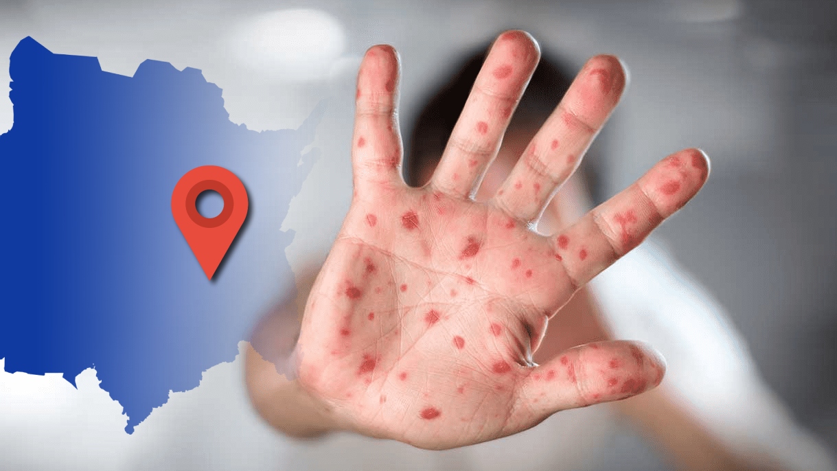 Registran tres nuevos casos de sarampión en Jonacatepec