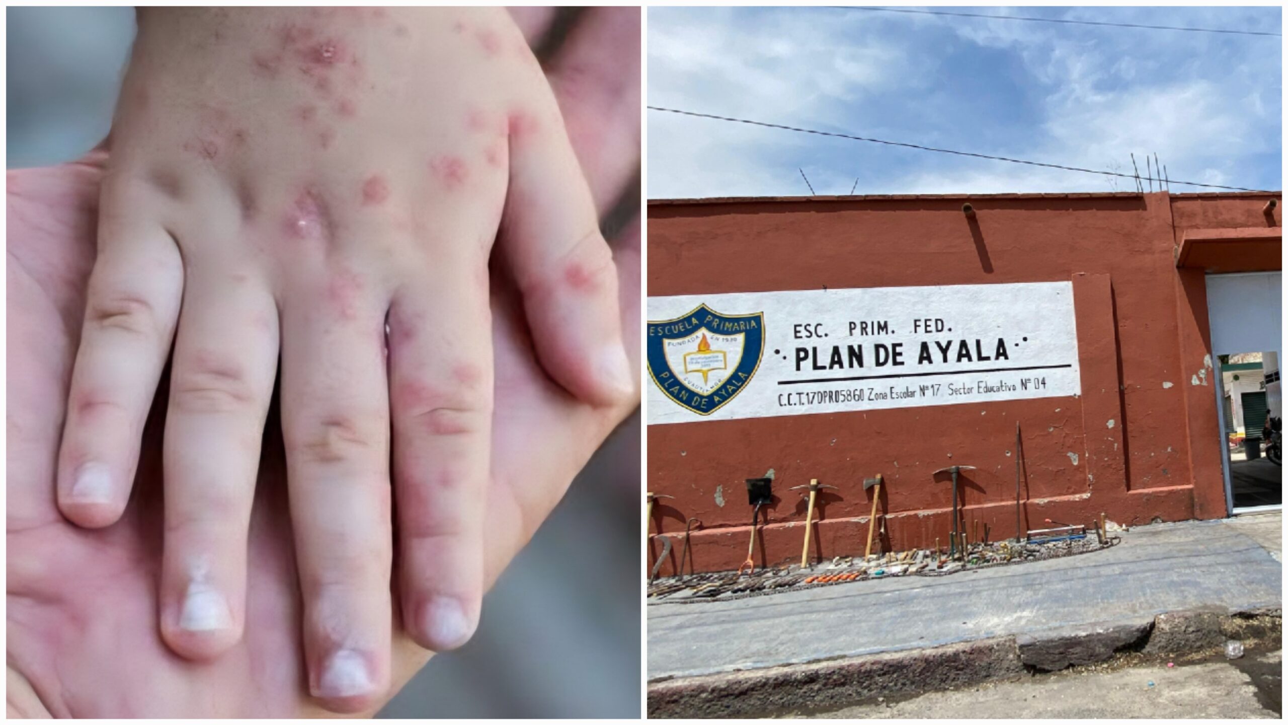 Escuelas refuerzan medidas sanitarias ante aumento de casos de sarampión