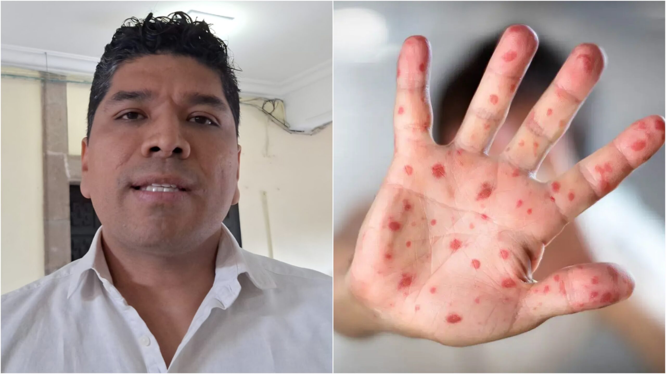 Confirman primer brote de sarampión en Coatetelco; hay 10 contagios