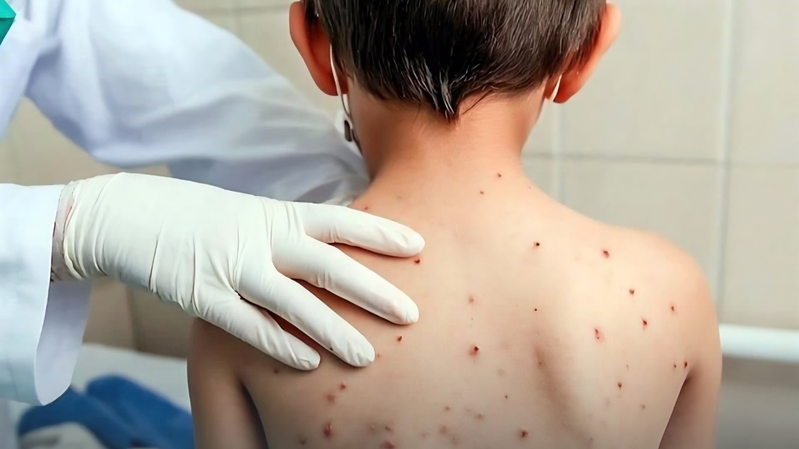 Suman 11 casos de sarampión en Morelos