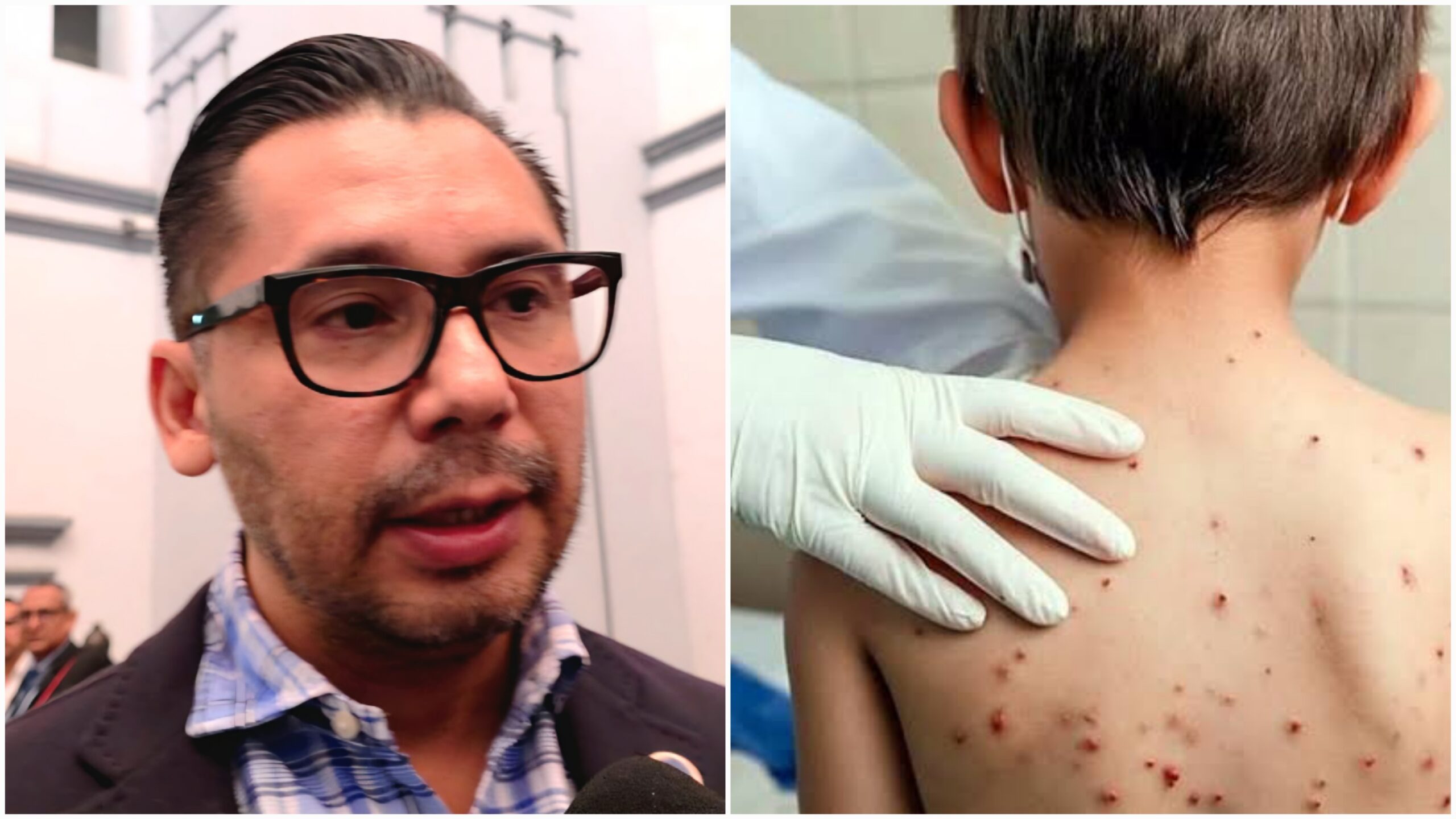 Casos de sarampión se concentran en menores sin vacunación