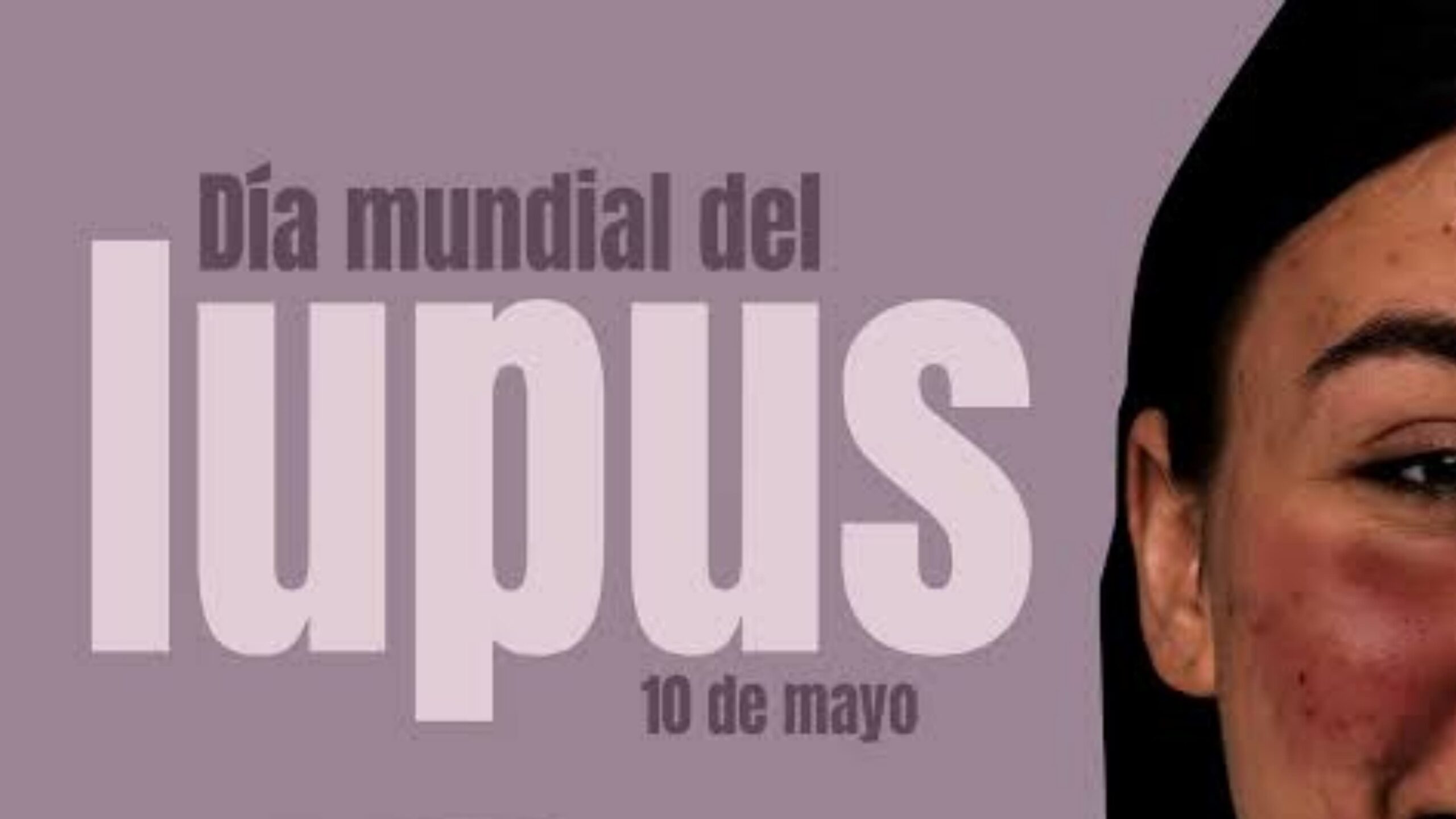 Lupus, la enfermedad de las mujeres de 15 a 45 años