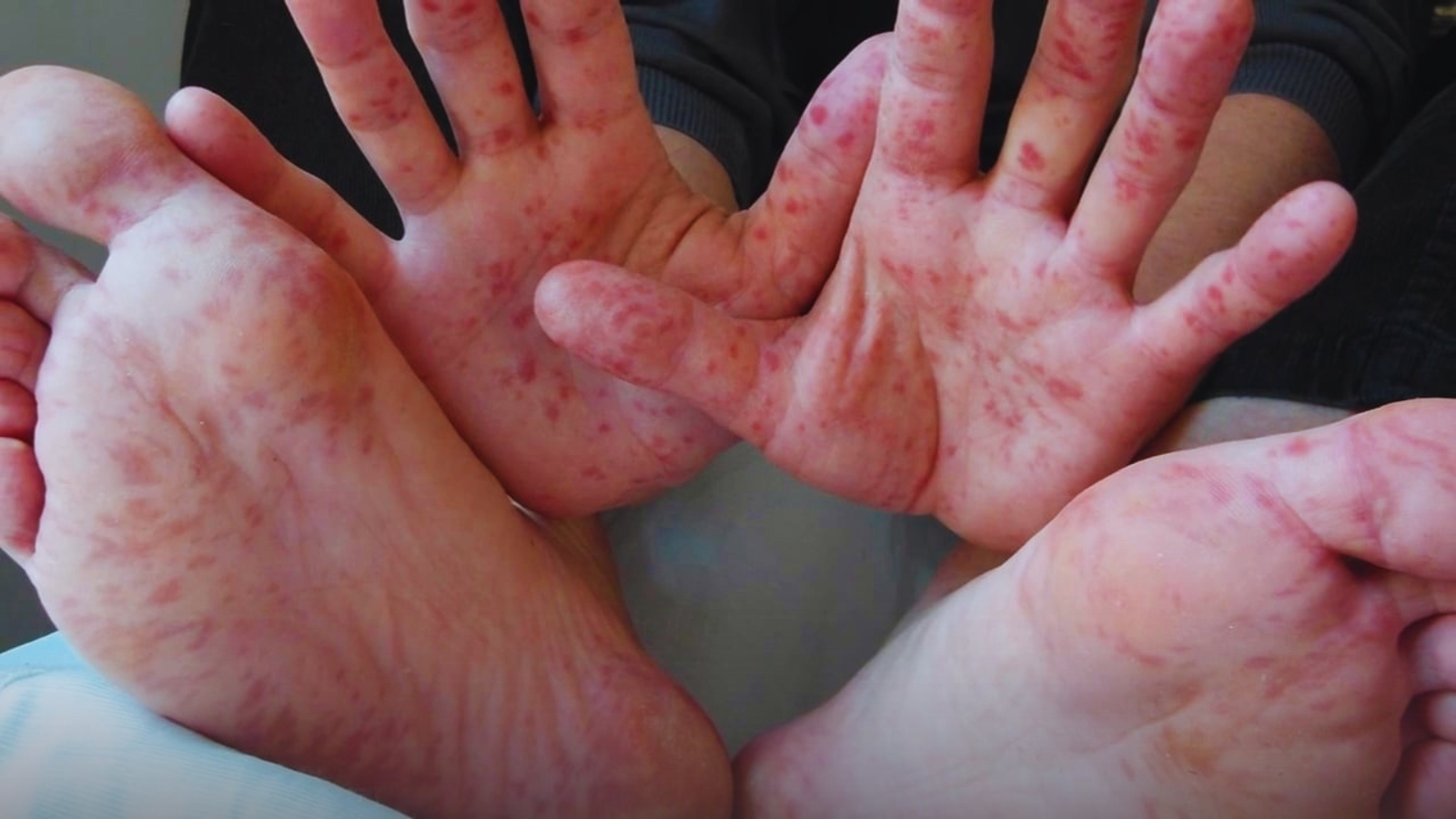 Alertan por virus Coxsackie; piden reforzar medidas para proteger a menores