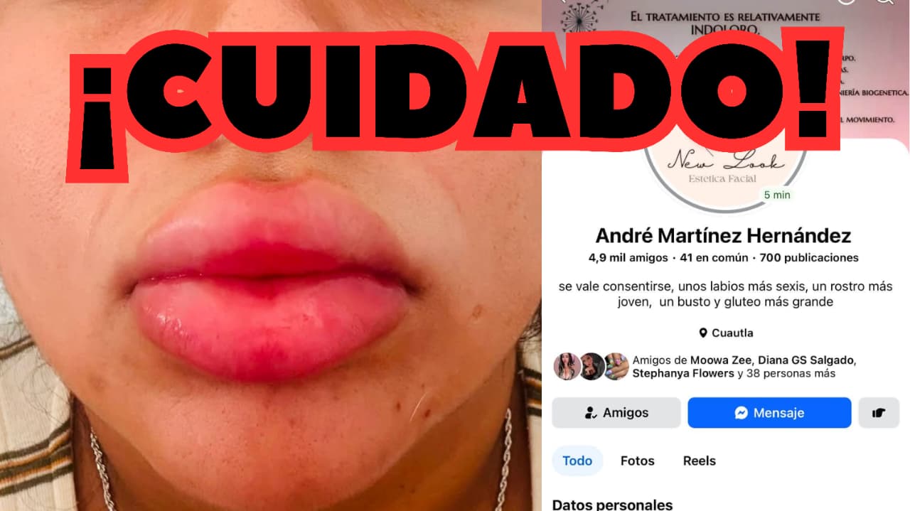 Joven en Cuautla sufre intoxicación luego de que le inyectaran aceite en los labios
